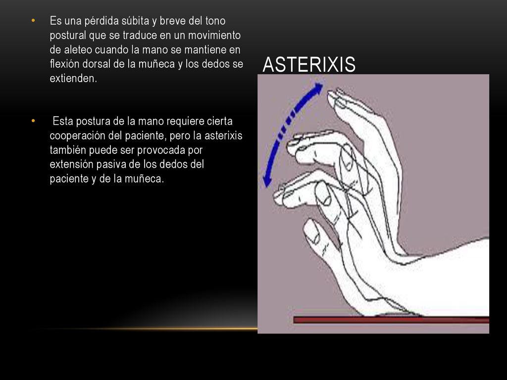 Es una pérdida súbita y breve del tono postural que se traduce en un movimiento de aleteo cuando la mano se mantiene en flexión dorsal de la muñeca y los dedos se extienden.