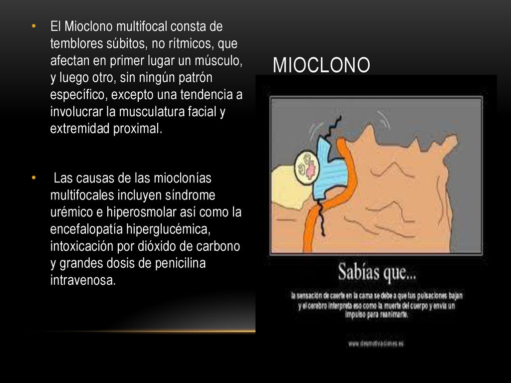 El Mioclono multifocal consta de temblores súbitos, no rítmicos, que afectan en primer lugar un músculo, y luego otro, sin ningún patrón específico, excepto una tendencia a involucrar la musculatura facial y extremidad proximal.