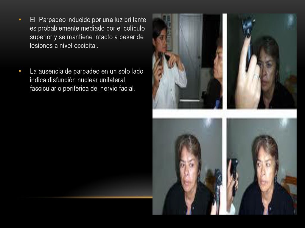 El Parpadeo inducido por una luz brillante es probablemente mediado por el colículo superior y se mantiene intacto a pesar de lesiones a nivel occipital.