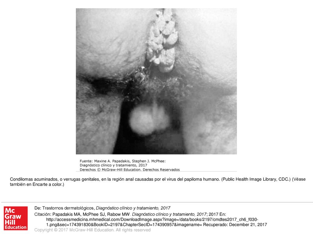 Condilomas acuminados, o verrugas genitales, en la región anal causadas por el virus del papiloma humano. (Public Health Image Library, CDC.) (Véase también en Encarte a color.)