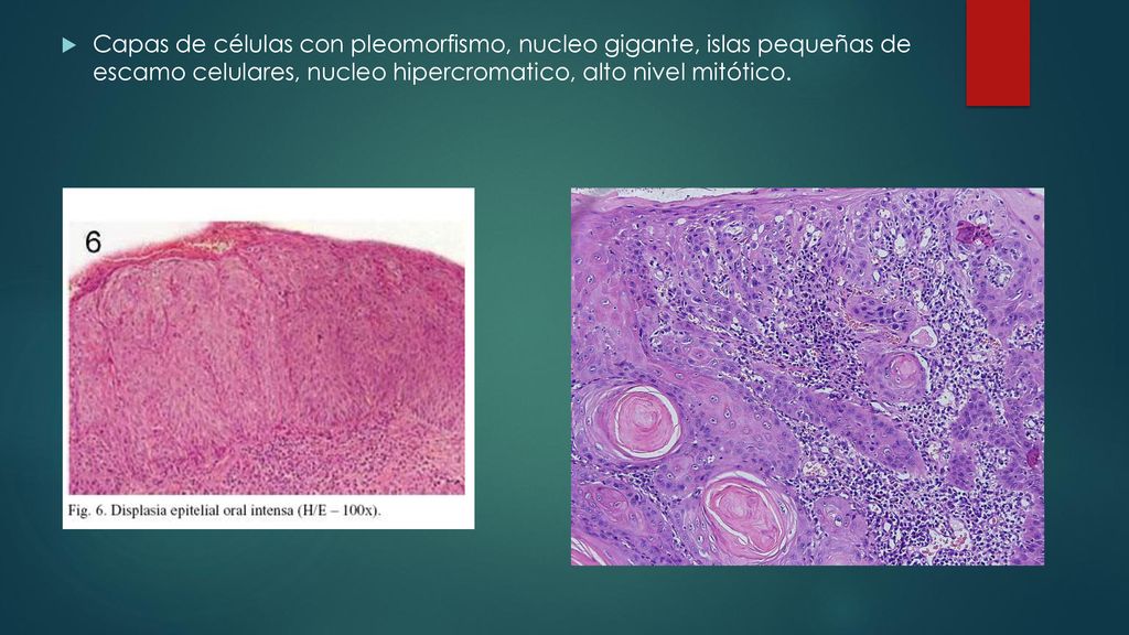 Capas de células con pleomorfismo, nucleo gigante, islas pequeñas de escamo celulares, nucleo hipercromatico, alto nivel mitótico.
