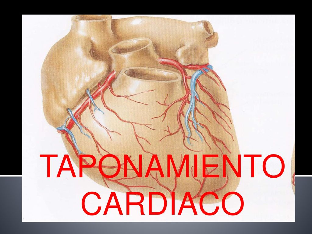 TAPONAMIENTO CARDIACO - Ppt Descargar