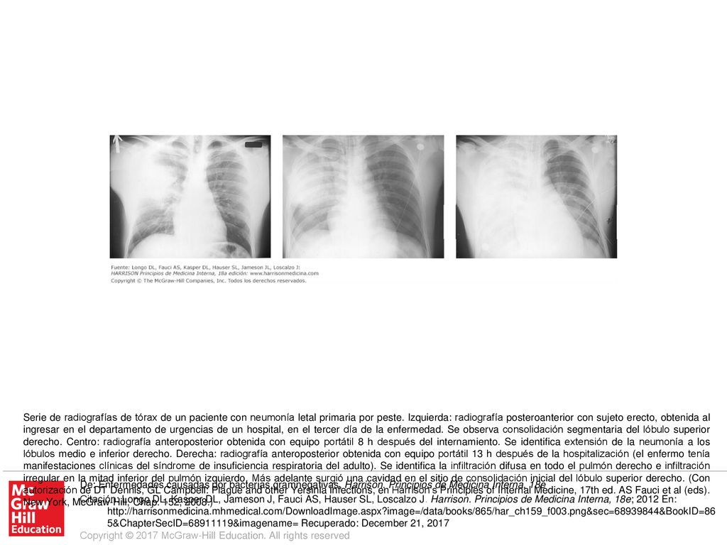Serie de radiografías de tórax de un paciente con neumonía letal primaria por peste. Izquierda: radiografía posteroanterior con sujeto erecto, obtenida al ingresar en el departamento de urgencias de un hospital, en el tercer día de la enfermedad. Se observa consolidación segmentaria del lóbulo superior derecho. Centro: radiografía anteroposterior obtenida con equipo portátil 8 h después del internamiento. Se identifica extensión de la neumonía a los lóbulos medio e inferior derecho. Derecha: radiografía anteroposterior obtenida con equipo portátil 13 h después de la hospitalización (el enfermo tenía manifestaciones clínicas del síndrome de insuficiencia respiratoria del adulto). Se identifica la infiltración difusa en todo el pulmón derecho e infiltración irregular en la mitad inferior del pulmón izquierdo. Más adelante surgió una cavidad en el sitio de consolidación inicial del lóbulo superior derecho. (Con autorización de DT Dennis, GL Campbell: Plague and other Yersinia infections, en Harrison’s Principles of Internal Medicine, 17th ed. AS Fauci et al (eds). New York, McGraw-Hill, Chap. 152, 2008.)