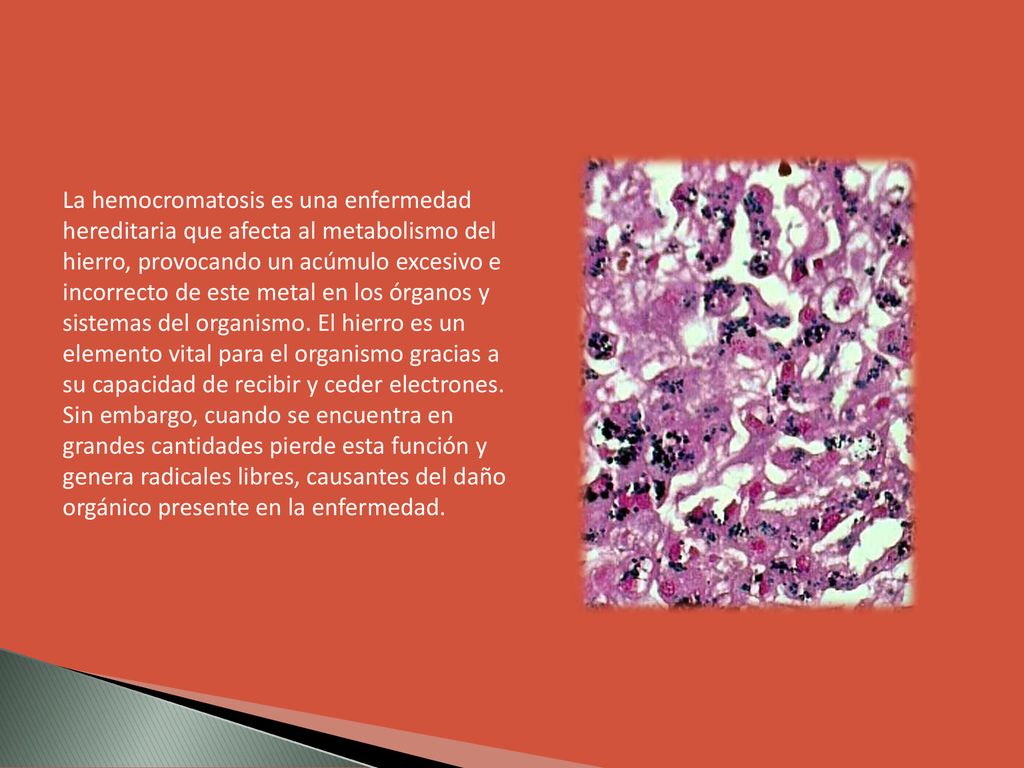 La hemocromatosis es una enfermedad hereditaria que afecta al metabolismo del hierro, provocando un acúmulo excesivo e incorrecto de este metal en los órganos y sistemas del organismo.