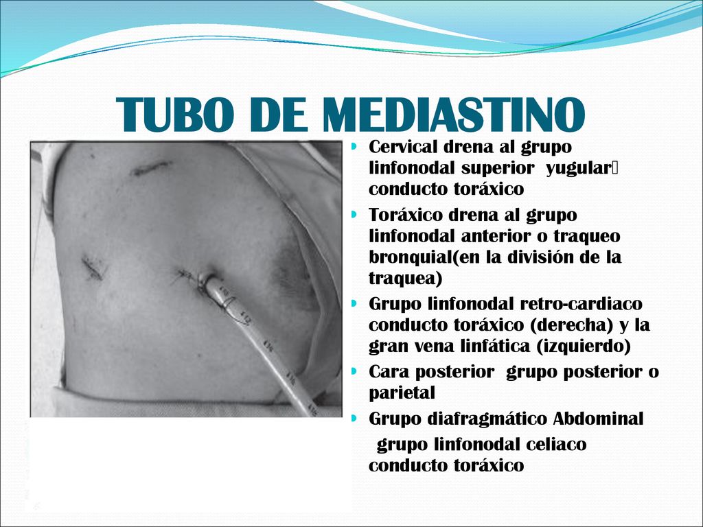 TUBO DE MEDIASTINO Cervical drena al grupo linfonodal superior yugular conducto toráxico.