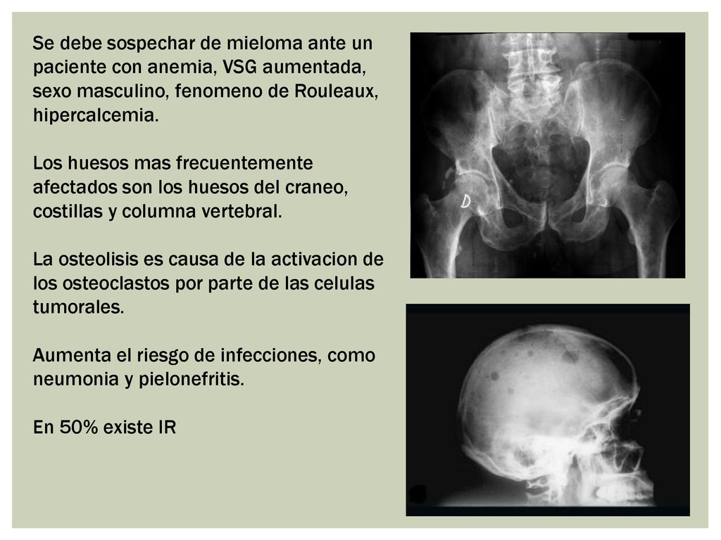 Se debe sospechar de mieloma ante un paciente con anemia, VSG aumentada, sexo masculino, fenomeno de Rouleaux, hipercalcemia.