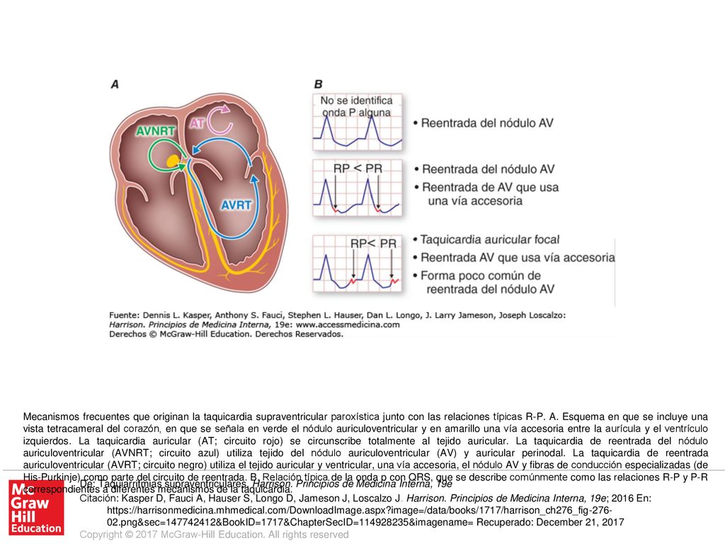 Mecanismos frecuentes que originan la taquicardia supraventricular paroxística junto con las relaciones típicas R-P. A. Esquema en que se incluye una vista tetracameral del corazón, en que se señala en verde el nódulo auriculoventricular y en amarillo una vía accesoria entre la aurícula y el ventrículo izquierdos. La taquicardia auricular (AT; circuito rojo) se circunscribe totalmente al tejido auricular. La taquicardia de reentrada del nódulo auriculoventricular (AVNRT; circuito azul) utiliza tejido del nódulo auriculoventricular (AV) y auricular perinodal. La taquicardia de reentrada auriculoventricular (AVRT; circuito negro) utiliza el tejido auricular y ventricular, una vía accesoria, el nódulo AV y fibras de conducción especializadas (de His-Purkinje) como parte del circuito de reentrada. B. Relación típica de la onda p con QRS, que se describe comúnmente como las relaciones R-P y P-R correspondientes a diferentes mecanismos de la taquicardia.