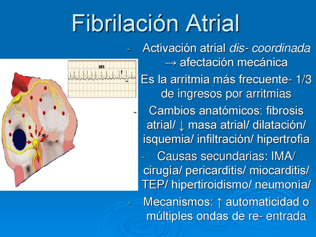 Fibrilación Atrial Activación atrial dis- coordinada → afectación mecánica. Es la arritmia más frecuente- 1/3 de ingresos por arritmias.