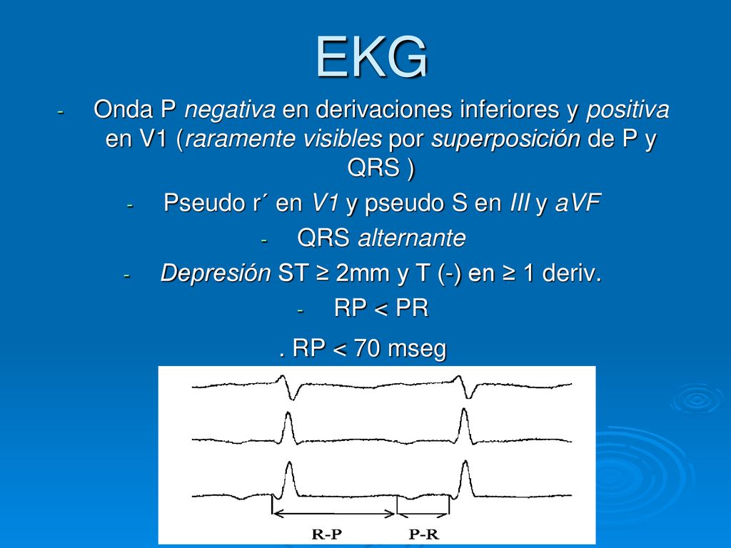 EKG Onda P negativa en derivaciones inferiores y positiva en V1 (raramente visibles por superposición de P y QRS )