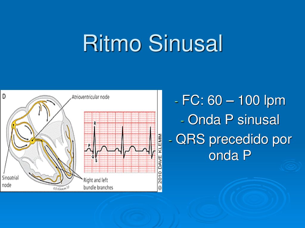 FC: 60 – 100 lpm Onda P sinusal QRS precedido por onda P