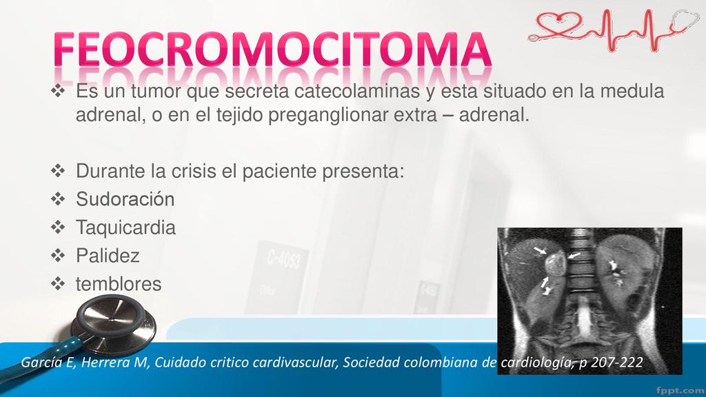 Feocromocitoma Es un tumor que secreta catecolaminas y esta situado en la medula adrenal, o en el tejido preganglionar extra – adrenal.