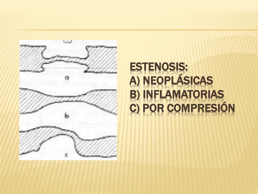 Estenosis: a) Neoplásicas b) Inflamatorias c) Por Compresión