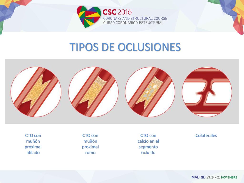 TIPOS DE OCLUSIONES CTO con muñón proximal afilado