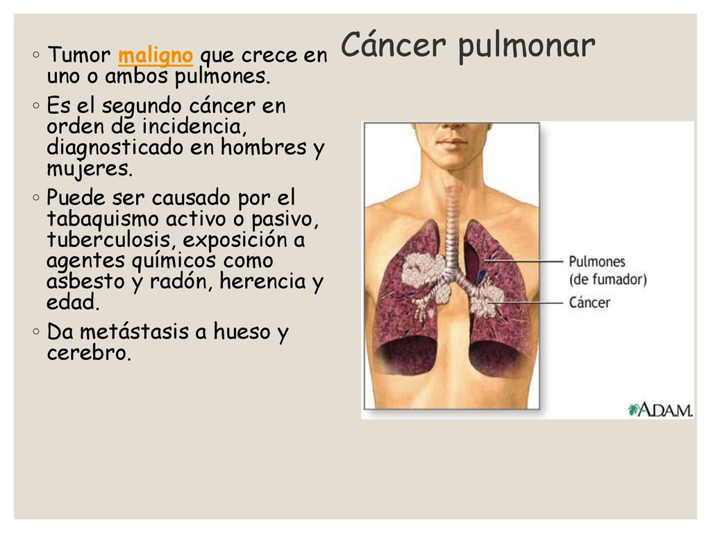 Cáncer pulmonar Tumor maligno que crece en uno o ambos pulmones.