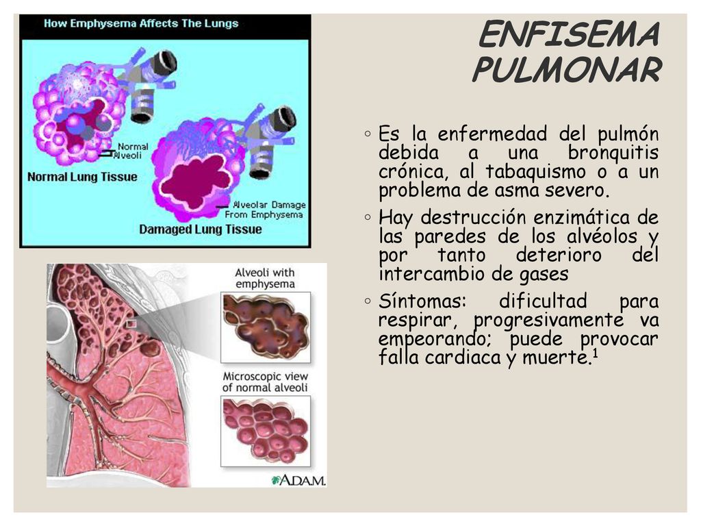 ENFISEMA PULMONAR Es la enfermedad del pulmón debida a una bronquitis crónica, al tabaquismo o a un problema de asma severo.