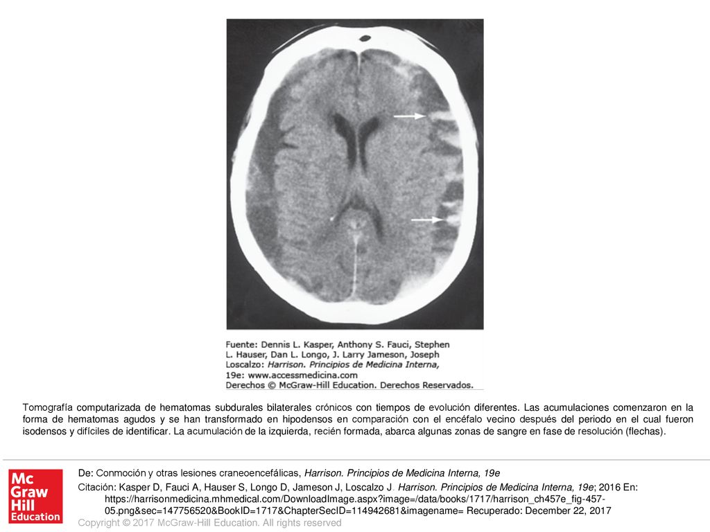 Tomografía computarizada de hematomas subdurales bilaterales crónicos con tiempos de evolución diferentes. Las acumulaciones comenzaron en la forma de hematomas agudos y se han transformado en hipodensos en comparación con el encéfalo vecino después del periodo en el cual fueron isodensos y difíciles de identificar. La acumulación de la izquierda, recién formada, abarca algunas zonas de sangre en fase de resolución (flechas).