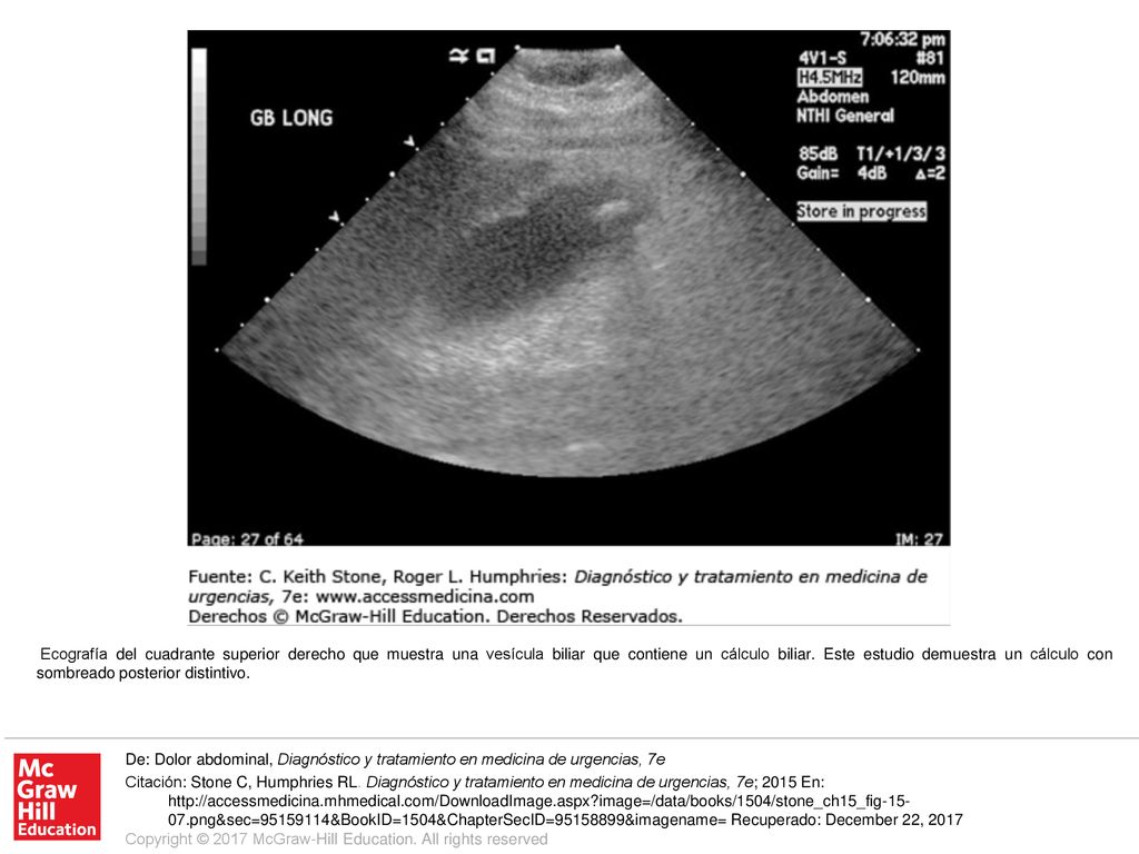 Ecografía del cuadrante superior derecho que muestra una vesícula biliar que contiene un cálculo biliar. Este estudio demuestra un cálculo con sombreado posterior distintivo.