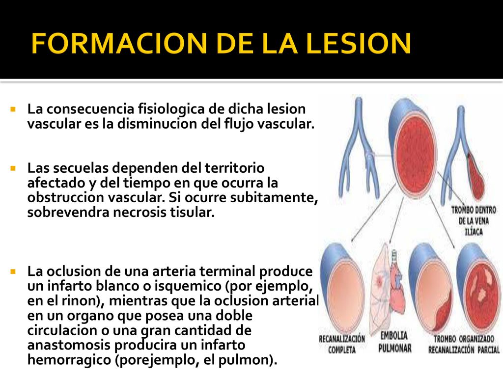 FORMACION DE LA LESION La consecuencia fisiologica de dicha lesion vascular es la disminucion del flujo vascular.