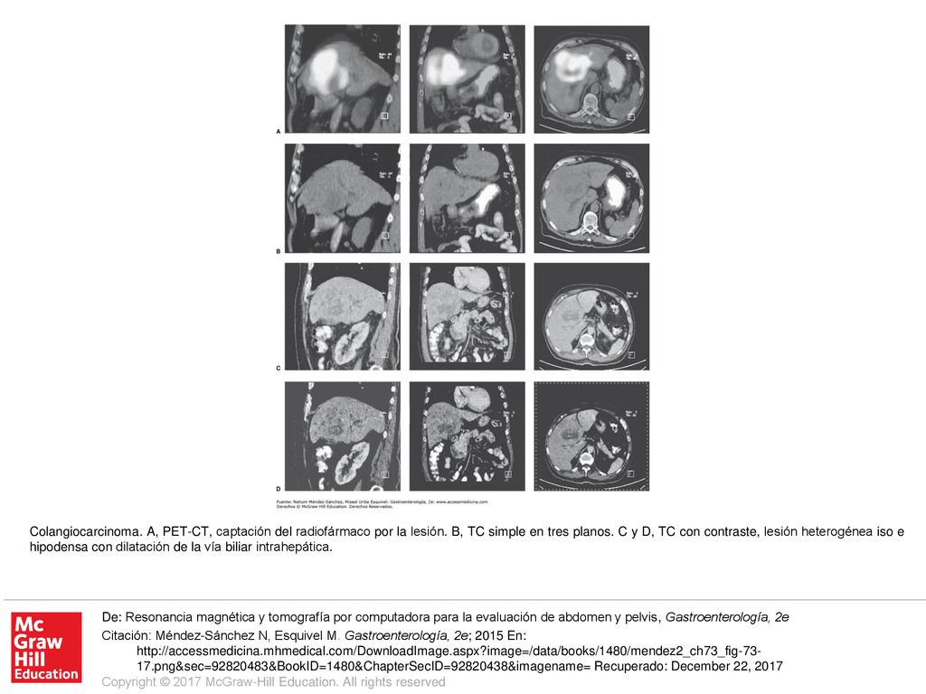 Colangiocarcinoma. A, PET-CT, captación del radiofármaco por la lesión