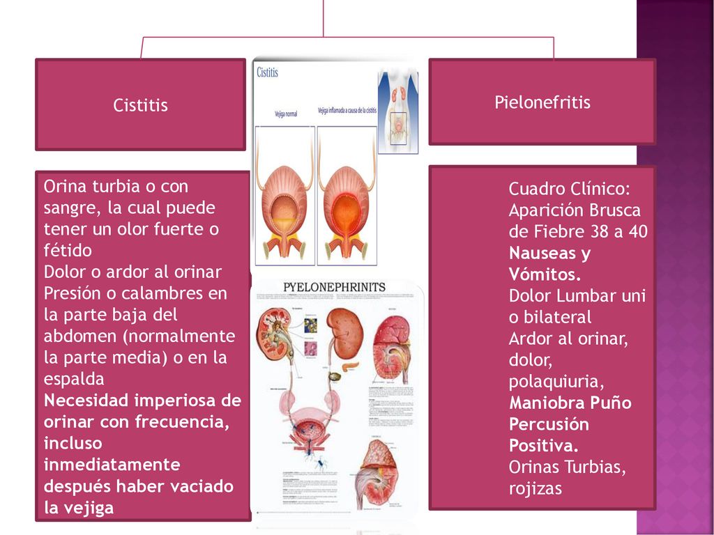 Cistitis Pielonefritis. Cuadro Clínico: Aparición Brusca de Fiebre 38 a 40 Nauseas y Vómitos. Dolor Lumbar uni o bilateral.