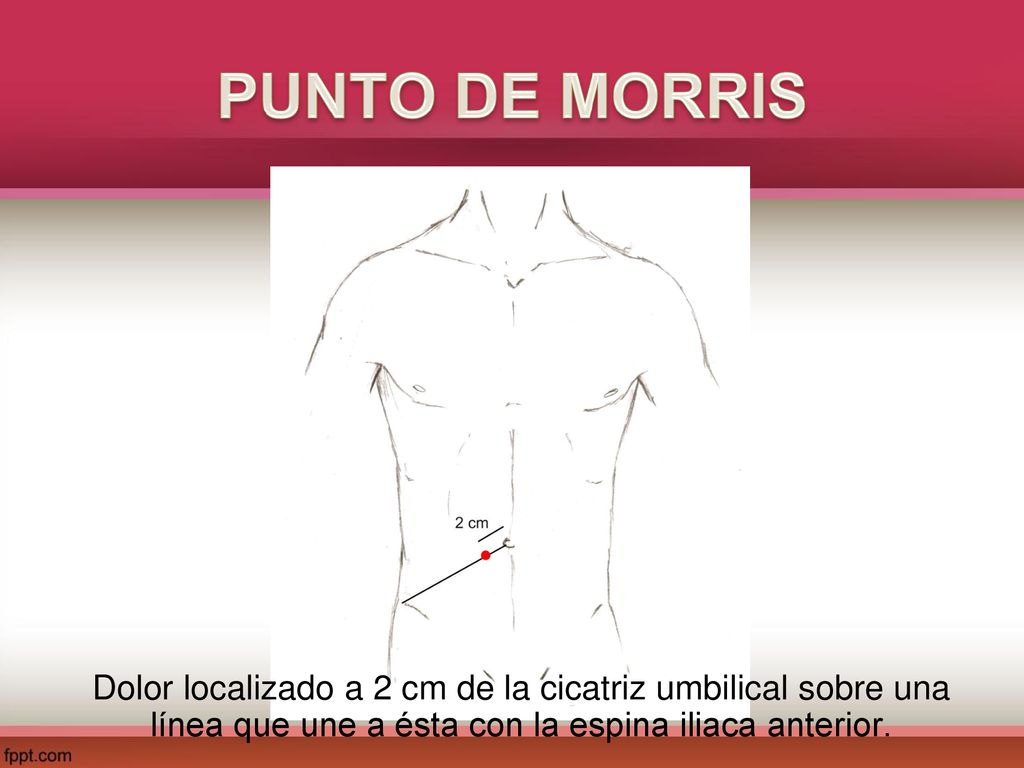 PUNTO DE MORRIS Dolor localizado a 2 cm de la cicatriz umbilical sobre una línea que une a ésta con la espina iliaca anterior.