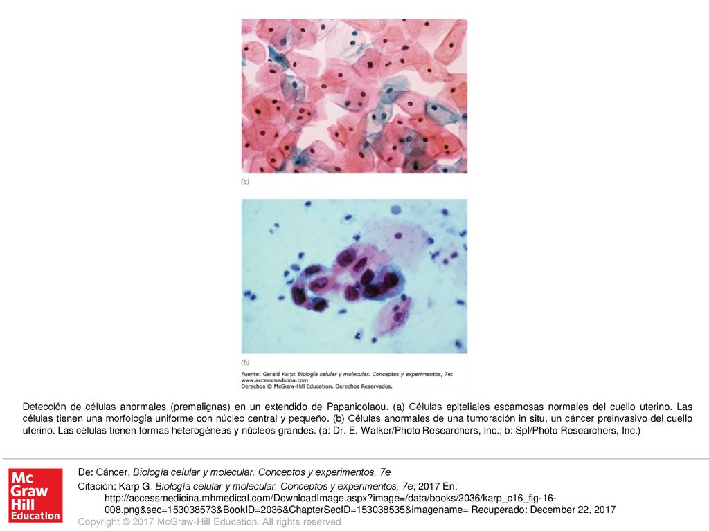 Detección de células anormales (premalignas) en un extendido de Papanicolaou. (a) Células epiteliales escamosas normales del cuello uterino. Las células tienen una morfología uniforme con núcleo central y pequeño. (b) Células anormales de una tumoración in situ, un cáncer preinvasivo del cuello uterino. Las células tienen formas heterogéneas y núcleos grandes. (a: Dr. E. Walker/Photo Researchers, Inc.; b: Spl/Photo Researchers, Inc.)