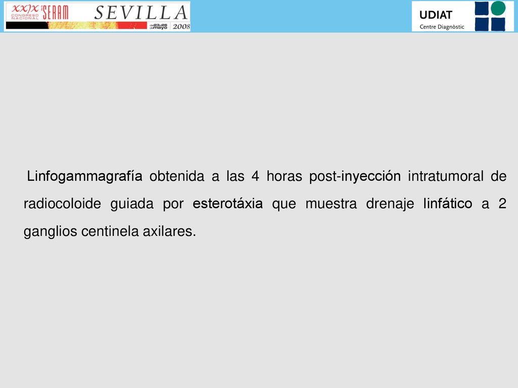 Linfogammagrafía obtenida a las 4 horas post-inyección intratumoral de radiocoloide guiada por esterotáxia que muestra drenaje linfático a 2 ganglios centinela axilares.