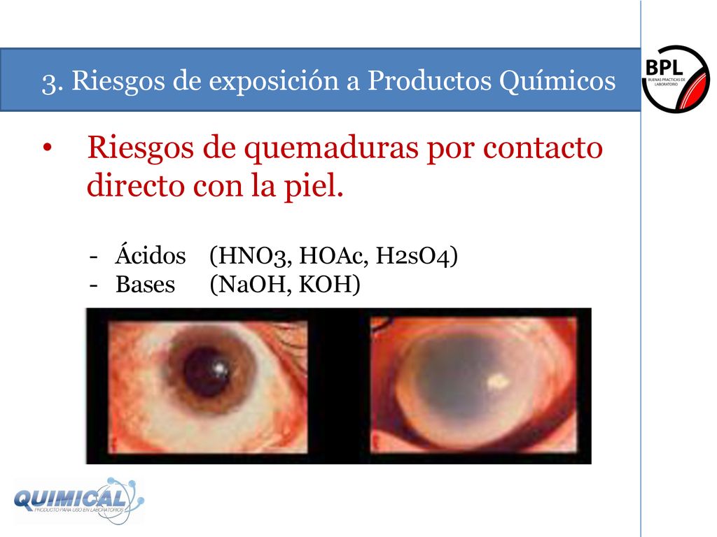 Riesgos de quemaduras por contacto directo con la piel.