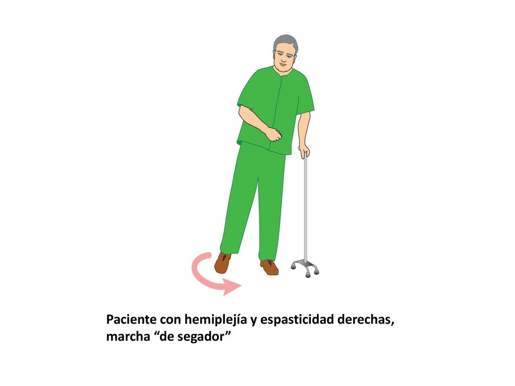 Paciente con hemiplejía y espasticidad derechas, marcha de segador