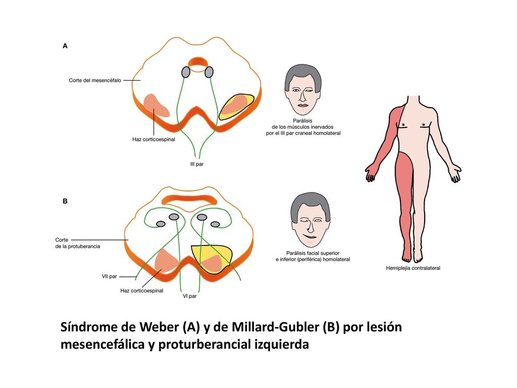 Síndrome de Weber (A) y de Millard-Gubler (B) por lesión mesencefálica y proturberancial izquierda
