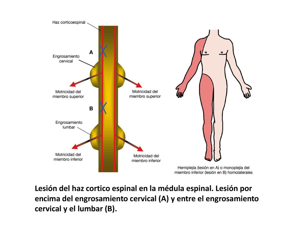 Lesión del haz cortico espinal en la médula espinal