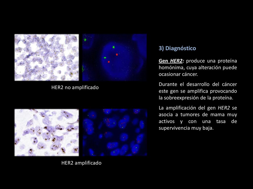 3) Diagnóstico Gen HER2: produce una proteína homónima, cuya alteración puede ocasionar cáncer.