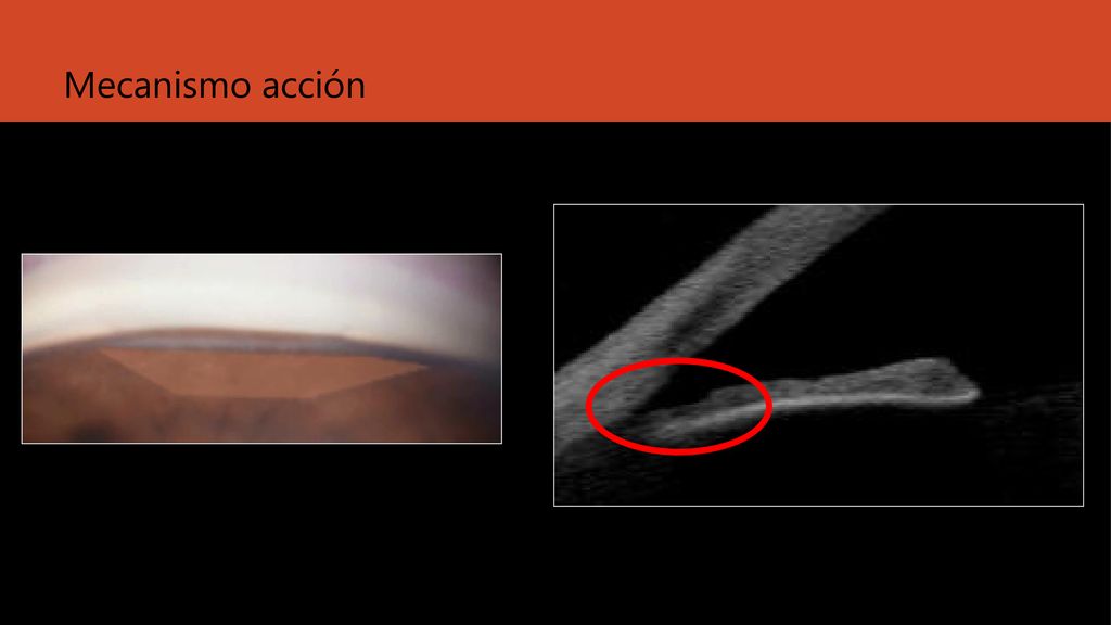Mecanismo acción Corectopia La ALPI dependiendo del grosor.