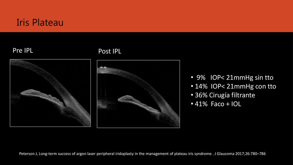 Iris Plateau Pre IPL Post IPL 9% IOP< 21mmHg sin tto