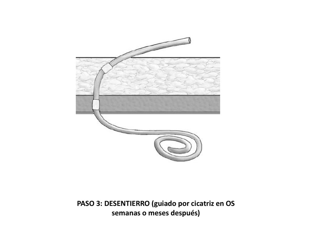 PASO 3: DESENTIERRO (guiado por cicatriz en OS semanas o meses después)
