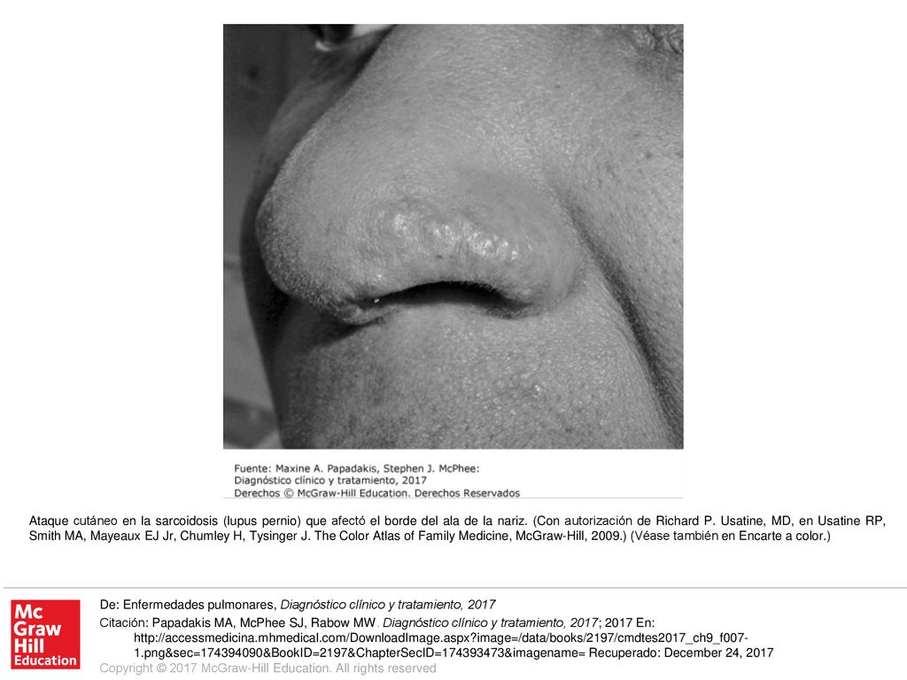 Ataque cutáneo en la sarcoidosis (lupus pernio) que afectó el borde del ala de la nariz. (Con autorización de Richard P. Usatine, MD, en Usatine RP, Smith MA, Mayeaux EJ Jr, Chumley H, Tysinger J. The Color Atlas of Family Medicine, McGraw-Hill, 2009.) (Véase también en Encarte a color.)