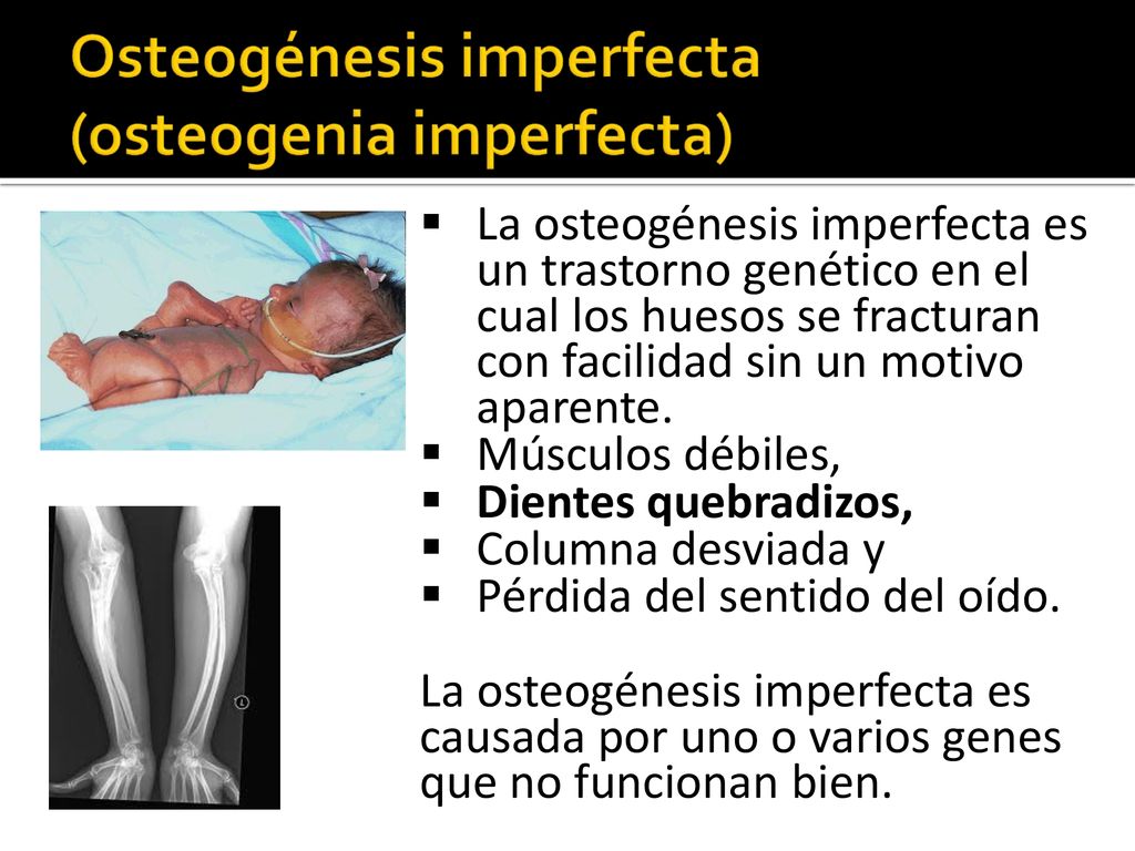 La osteogénesis imperfecta es un trastorno genético en el cual los huesos se fracturan con facilidad sin un motivo aparente.