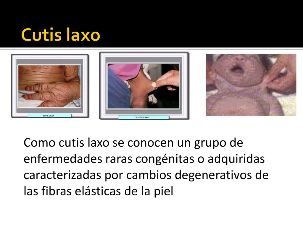 Como cutis laxo se conocen un grupo de enfermedades raras congénitas o adquiridas caracterizadas por cambios degenerativos de las fibras elásticas de la piel