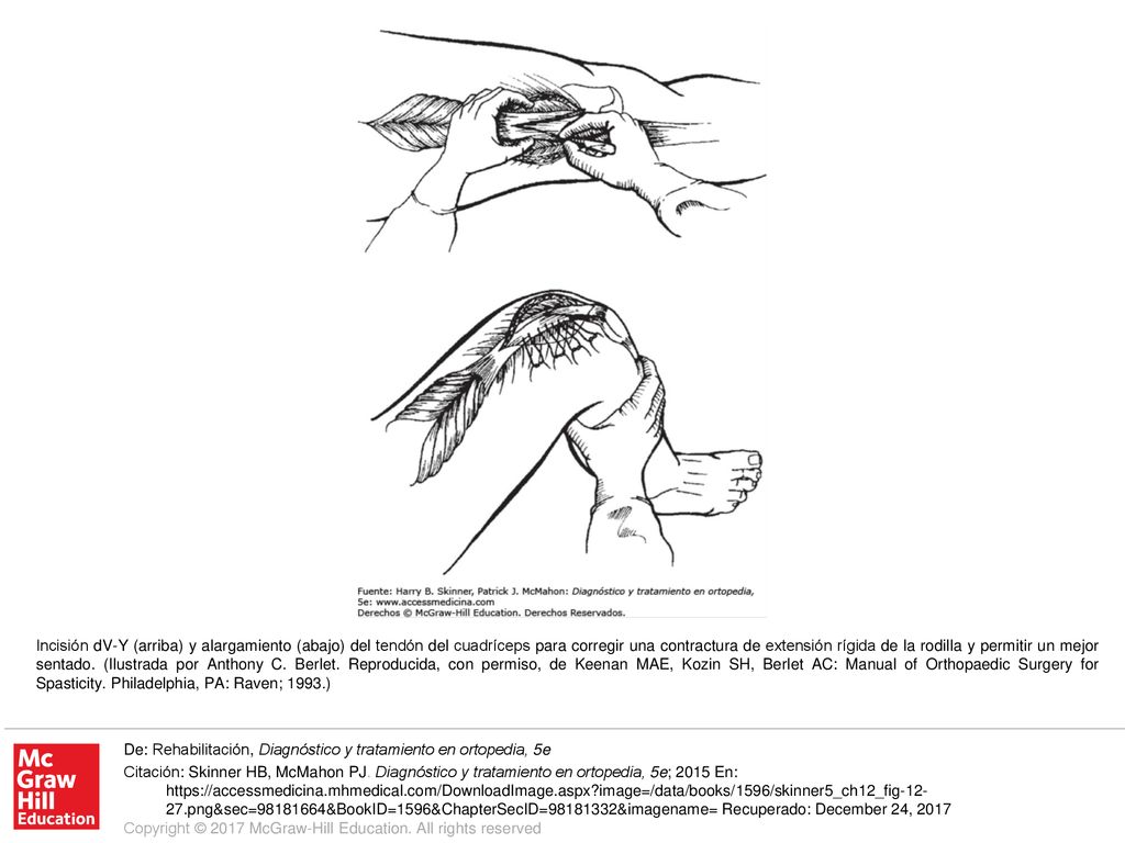 Incisión dV-Y (arriba) y alargamiento (abajo) del tendón del cuadríceps para corregir una contractura de extensión rígida de la rodilla y permitir un mejor sentado. (Ilustrada por Anthony C. Berlet. Reproducida, con permiso, de Keenan MAE, Kozin SH, Berlet AC: Manual of Orthopaedic Surgery for Spasticity. Philadelphia, PA: Raven; 1993.)