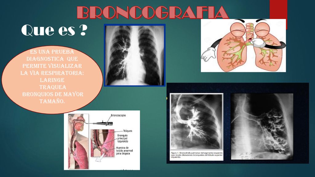 BRONCOGRAFIA Que es ES UNA PRUEBA DIAGNOSTICA QUE PERMITE VISUALIZAR LA VIA RESPIRATORIA: LARINGE.