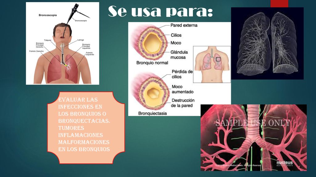 Se usa para: Evaluar las infecciones en los bronquios o bronquectacias.