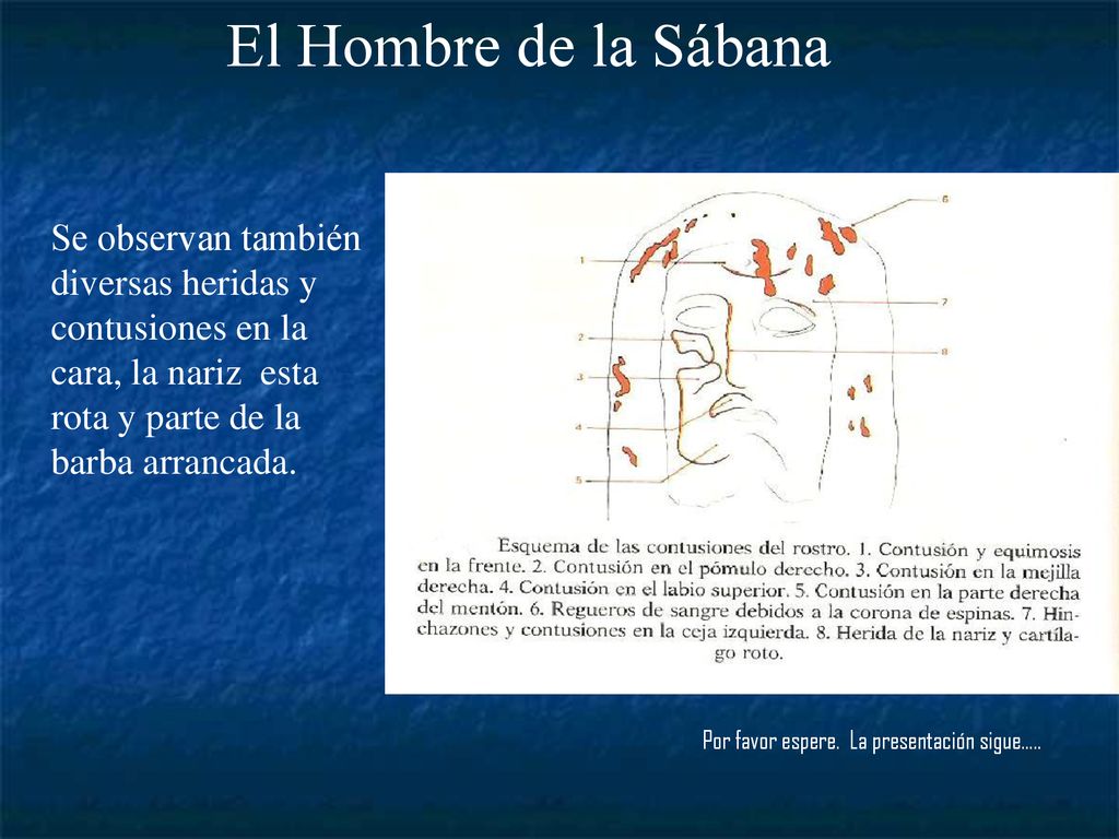 El Hombre de la Sábana Se observan también diversas heridas y contusiones en la cara, la nariz esta rota y parte de la barba arrancada.