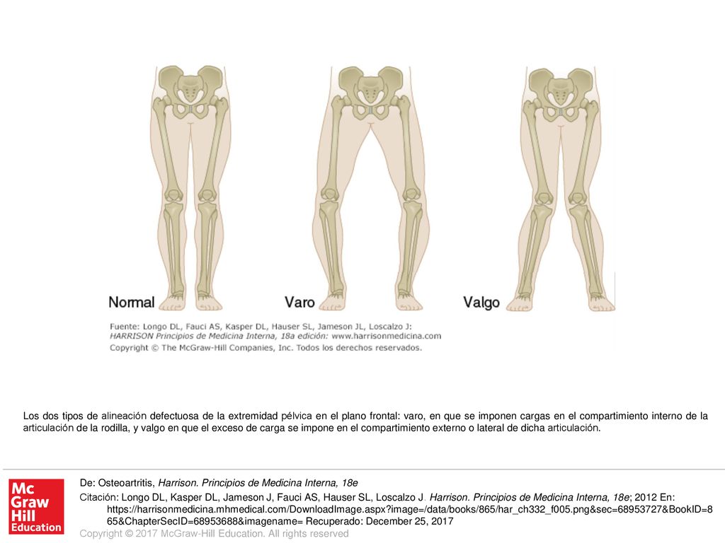 Los dos tipos de alineación defectuosa de la extremidad pélvica en el plano frontal: varo, en que se imponen cargas en el compartimiento interno de la articulación de la rodilla, y valgo en que el exceso de carga se impone en el compartimiento externo o lateral de dicha articulación.