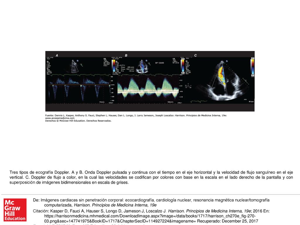 Tres tipos de ecografía Doppler. A y B