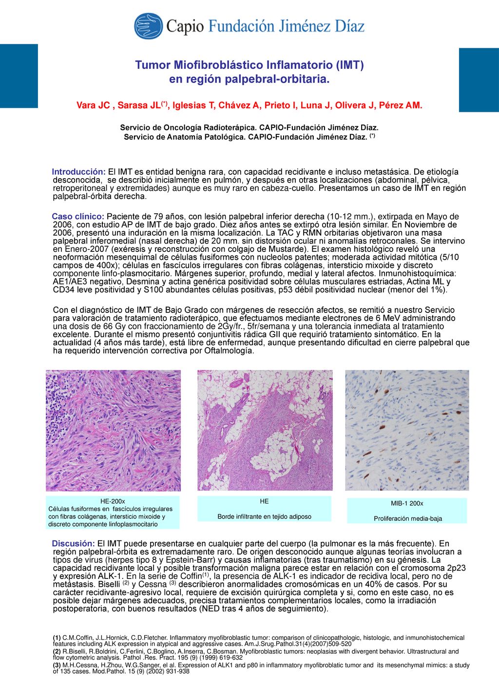 Tumor Miofibroblástico Inflamatorio (IMT) en región palpebral-orbitaria. Vara JC , Sarasa JL(*), Iglesias T, Chávez A, Prieto I, Luna J, Olivera J, Pérez AM. Servicio de Oncología Radioterápica. CAPIO-Fundación Jiménez Díaz. Servicio de Anatomía Patológica. CAPIO-Fundación Jiménez Díaz. (*)