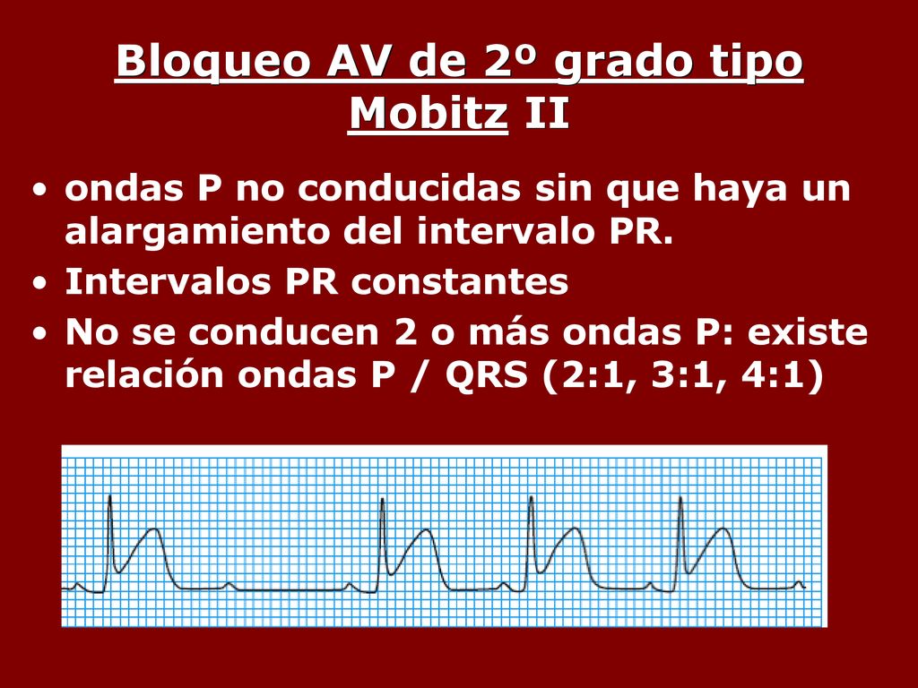 Bloqueo AV de 2º grado tipo Mobitz II
