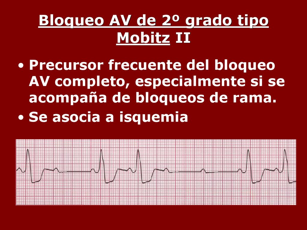 Bloqueo AV de 2º grado tipo Mobitz II
