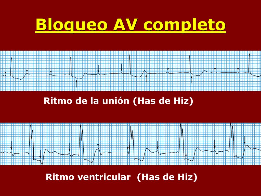 Bloqueo AV completo Ritmo de la unión (Has de Hiz)