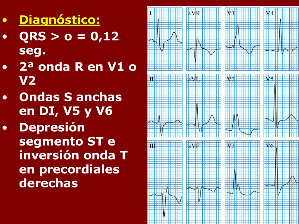 Diagnóstico: QRS > o = 0,12 seg. 2ª onda R en V1 o V2. Ondas S anchas en DI, V5 y V6.