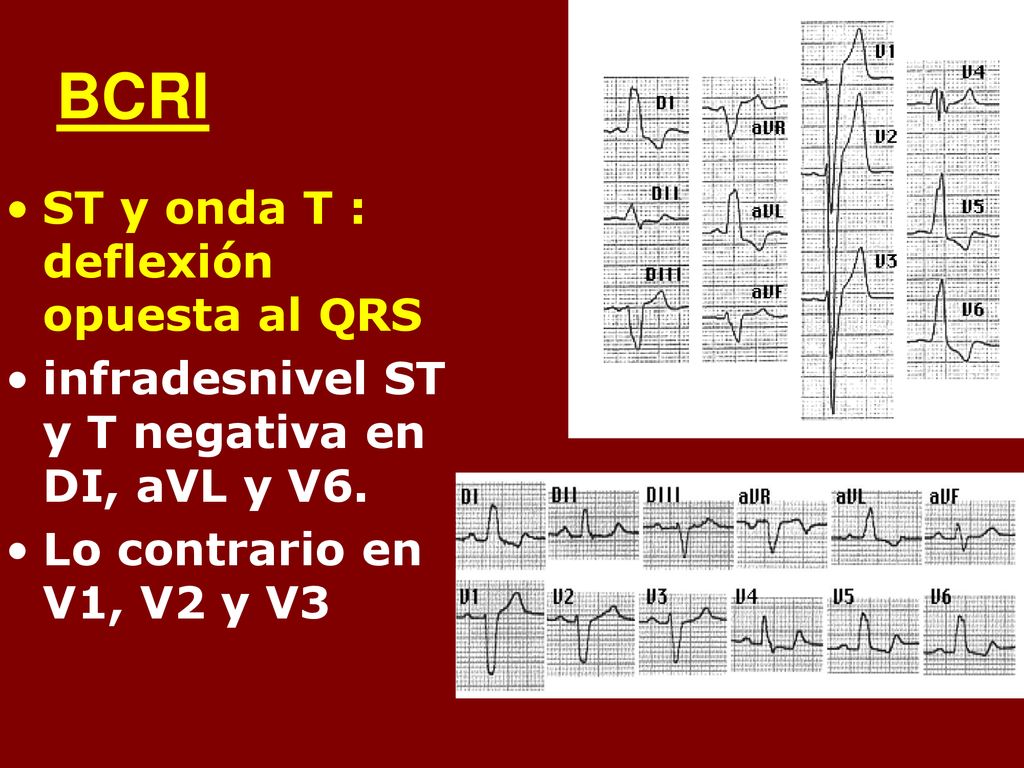 BCRI ST y onda T : deflexión opuesta al QRS